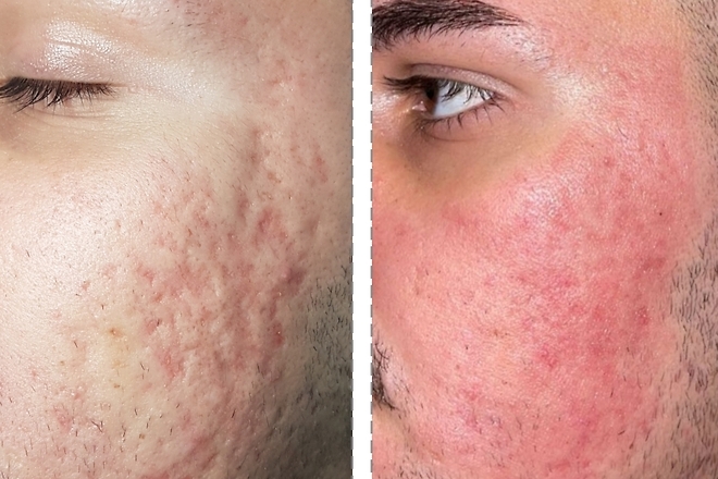 Reducera akneärr med CO2 laser.