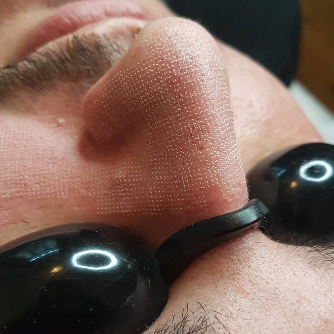 CO2 laser behandling i Stockholm