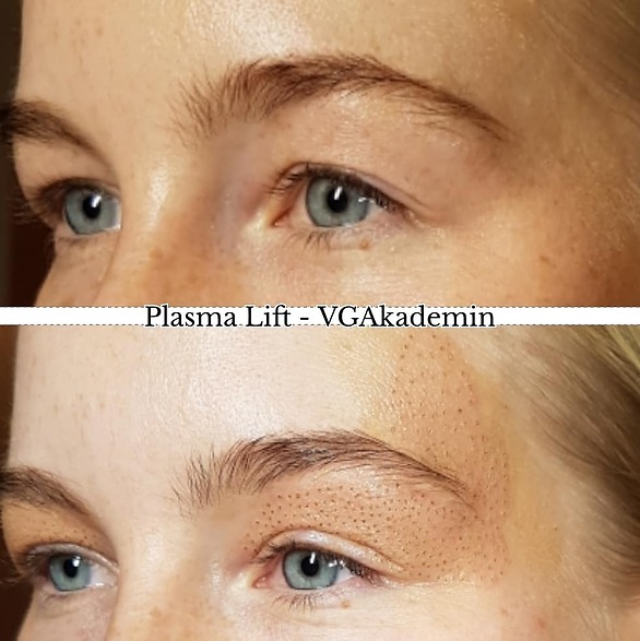 Plasma lift